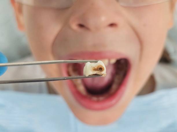 Best Emergency Dental Filling Replacement  in Han, GA